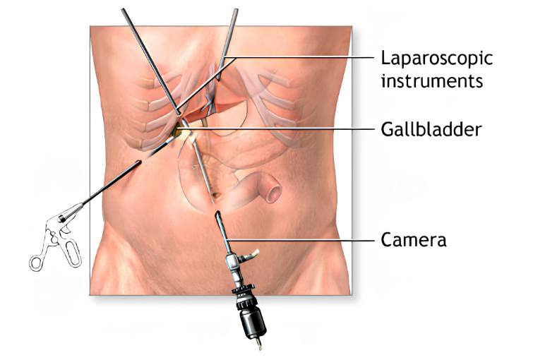 Gallbladder Removal - Service Image