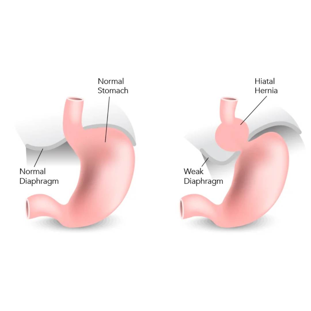 Hiatus Hernia (Reflux/GERD)