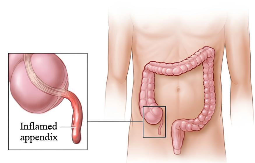 Appendectomy - Service Image