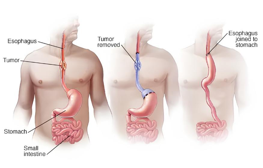 Esophagectomy for Esophageal Cancer