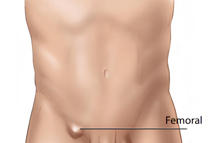Femoral Hernia