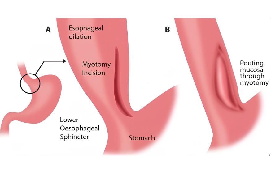 Laparoscopic Heller’s Cardiomyotomy for Achalasia Cardia