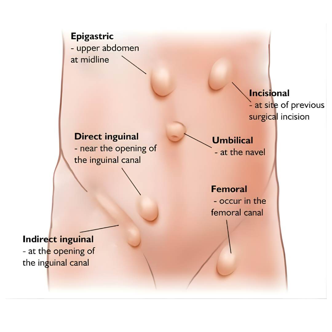 Hernia Surgery