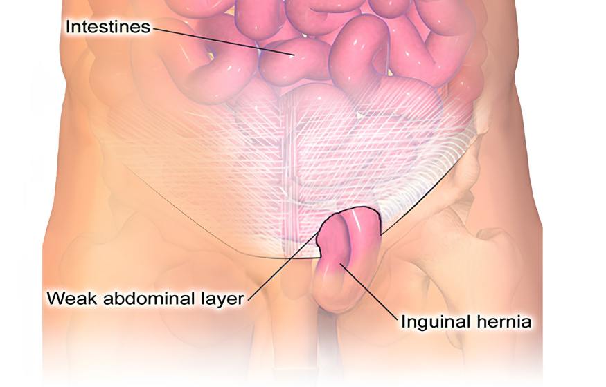 Inguinal Hernia