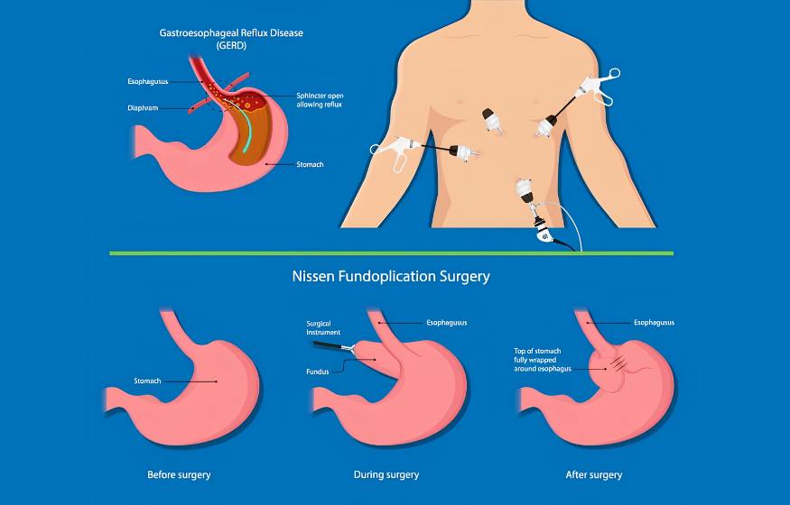 Laparoscopic Anti reflux surgery (fundoplication)