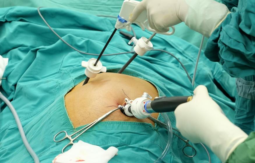 Laparoscopic Cholecystectomy (Gall stones)