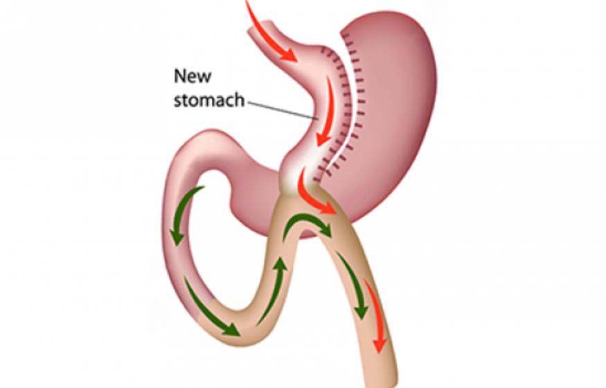 Mini Gastric Bypass - Service Image
