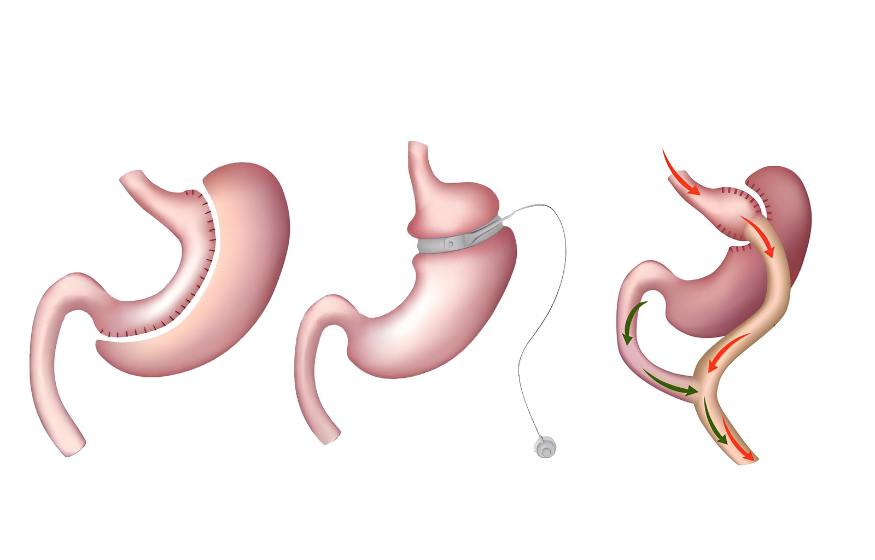 Revision Bariatric - Service Image