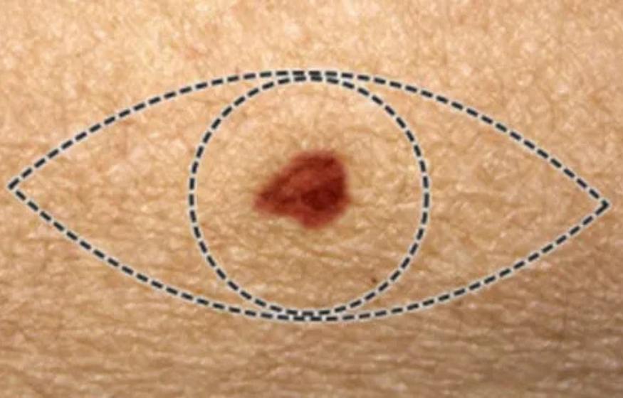 Skin Lesions