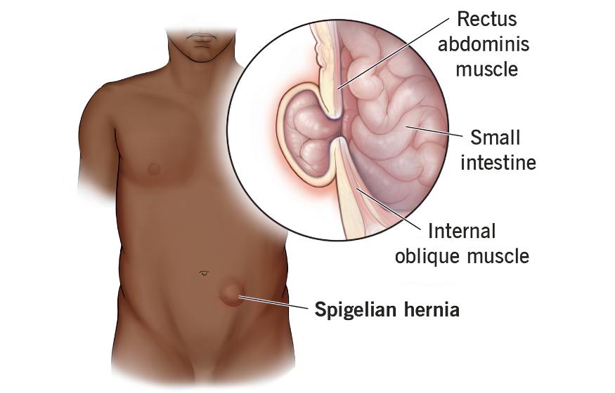 Spigelian Hernia