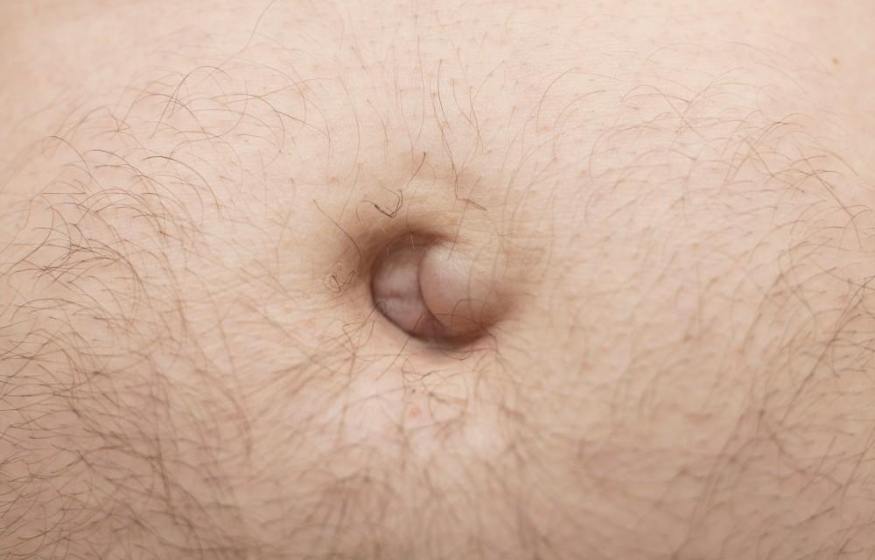 Umbilical Hernia
