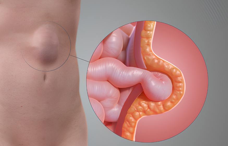 Ventral Hernia - Service Image