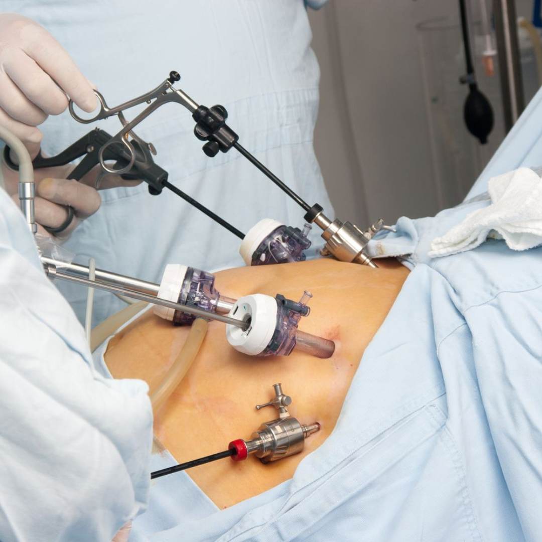 Weight Loss Surgery (Bariatric)